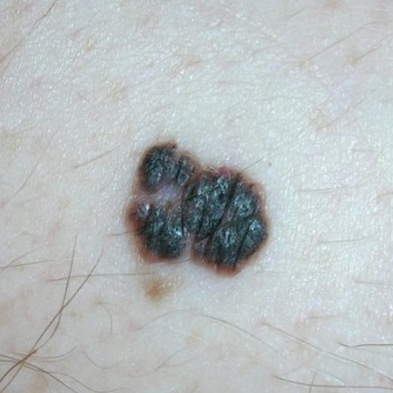 MELANOMA
