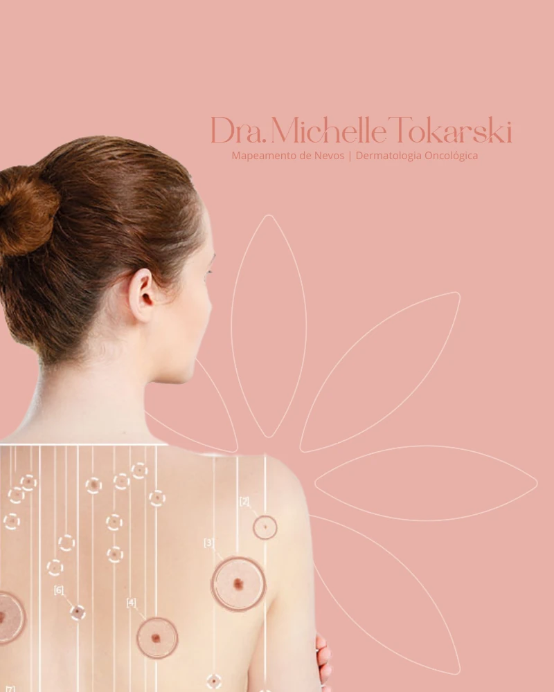 Dra. Michelle Tokarski - Mapeamento de Nevos e Dermatologia Oncológica