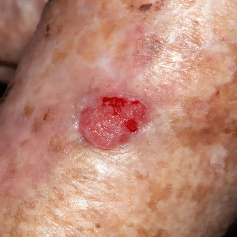 CARCINOMA ESPINOCELULAR
